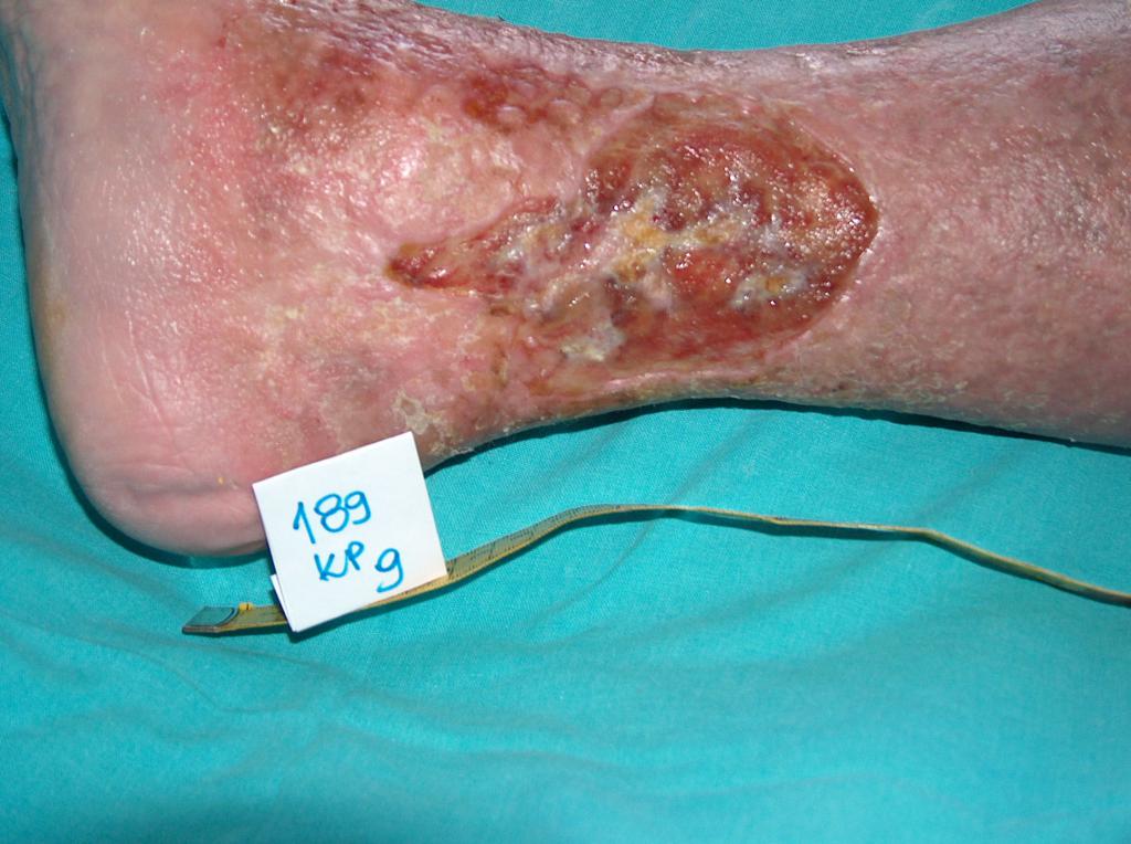 Fot 2. Owrzodzenie żylne w okolicy stawu skokowego (archiwum własne autorki)