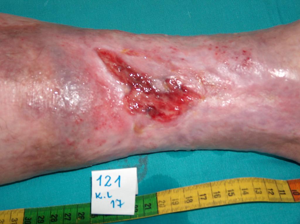 Fot. 4. Venengeschwür in der Endheilungsphase (eigenes Archiv der Autorin)