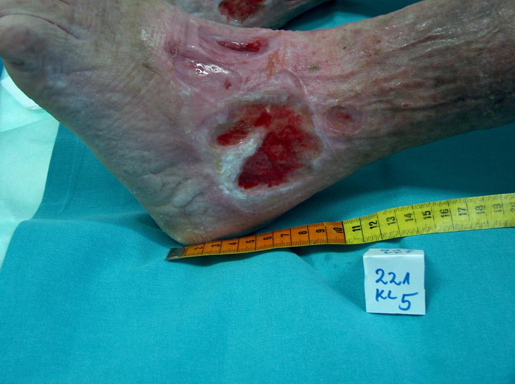 Fot. 3. Venengeschwür in der Sprunggelenkgegend (eigenes Archiv der Autorin)