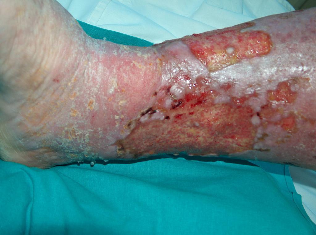 Fot. 1. Ringförmiger Venengeschwür (eigenes Archiv der Autorin)