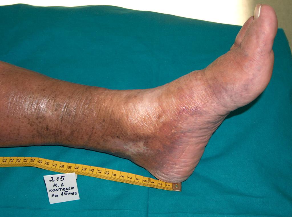 Fot. 8. Geheilte Venengeschwür, auf dem Emollientien angewandt wurden (eigenes Archiv der Autorin)